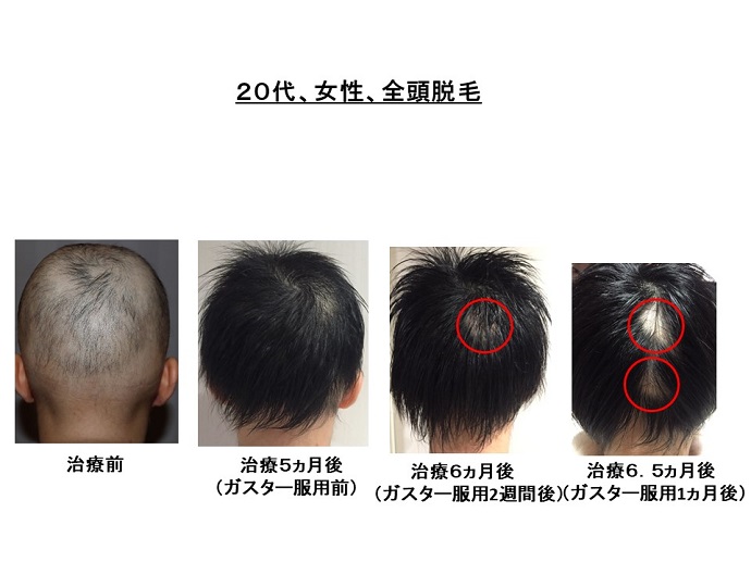 円形脱毛症　病院
